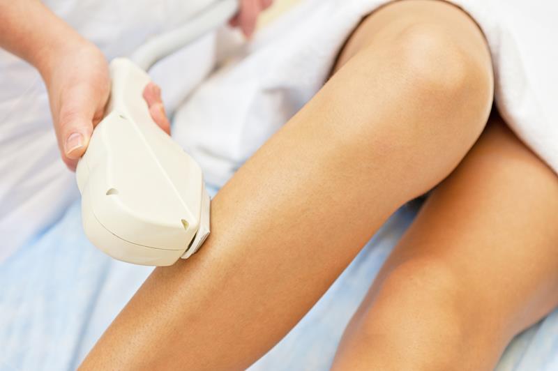 laser hair removal1